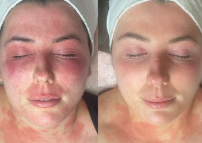 Before and after skin treatment.