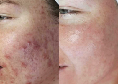 Before and after acne treatment