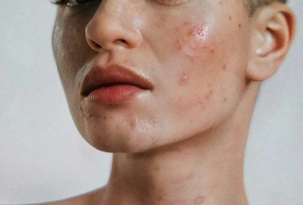Everything You Need to Know About Acne: Clearer Skin Starts Here