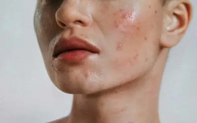 Everything You Need to Know About Acne: Clearer Skin Starts Here