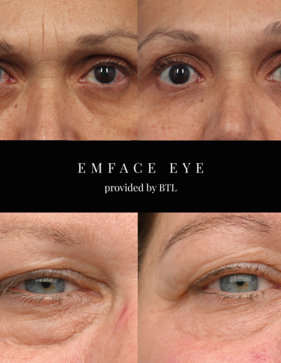 EMFace Eye Treatment, Cosmetic Clinic, Fillers Edinburgh, Botox Edinburgh | Mayfield Clinic