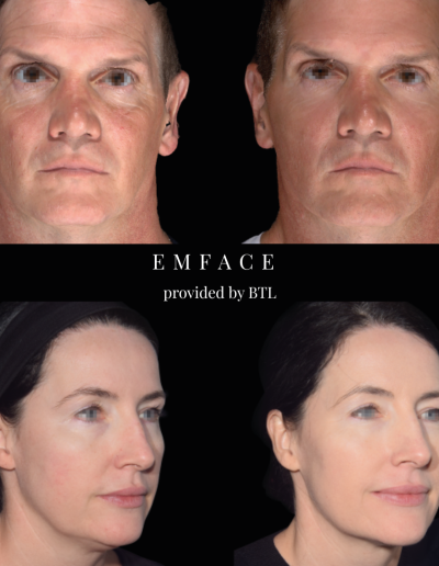 Full Face Treatment, EMFace, Cosmetic Clinic, Lip Fillers | Mayfield Clinic