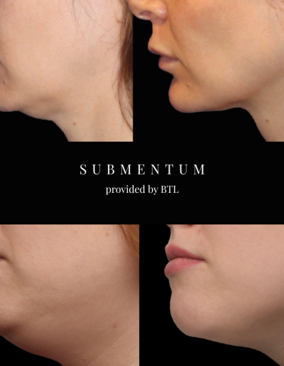 EMFace Under Chin Treatment, Cosmetic Clinic, Lip Fillers, Botox Edinburgh | Mayfield Clinic