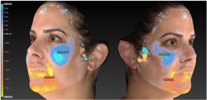 This 3D volumetric analysis shows facial volume changes in a person treated with EMFace. The blue areas indicate increased volume (notably in the midface), while orange/yellow areas indicate decreased volume (primarily in the lower face).