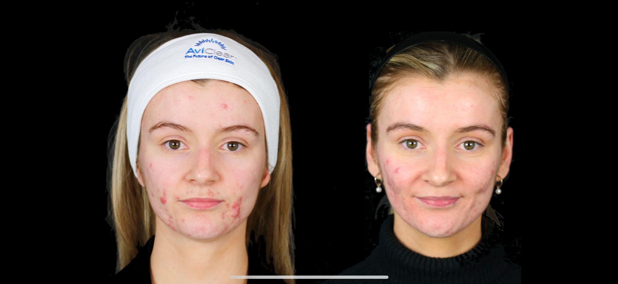 AviClear Results Acne treatment results , Edinburgh acne treatment