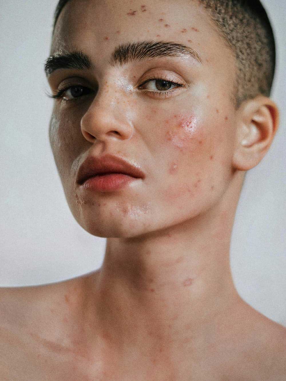 Real Skin with Acne – Close-Up Portrait Close-up portrait of a person with acne and natural skin texture, showcasing real and unretouched skin.