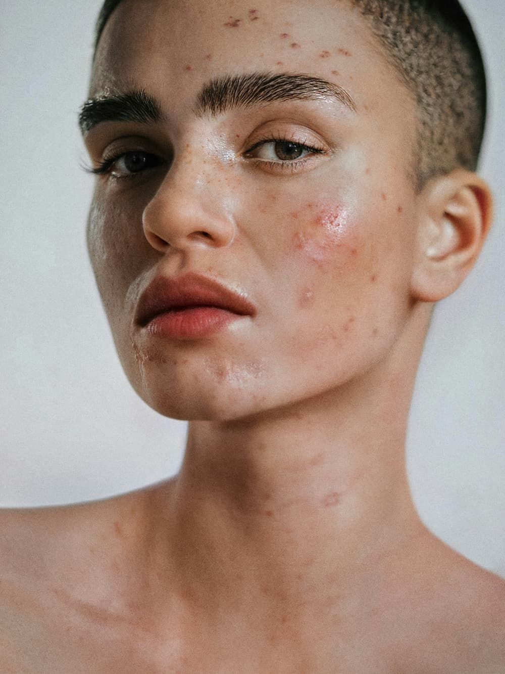 ACNE absolut-MfBcYLzHdsI-unsplash (1)